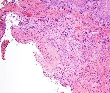 Figure 10.2, Mycobacterium tuberculosis .