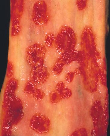 Figure 10.4, Gross appearance of esophageal ulcers due to herpes esophagitis in a patient with human immunodeficiency virus infection. Numerous punched-out ulcers are present.