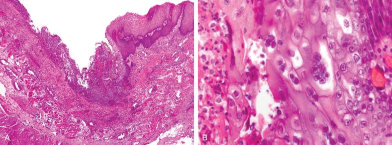 Figure 10.5, Herpes simplex virus esophagitis.