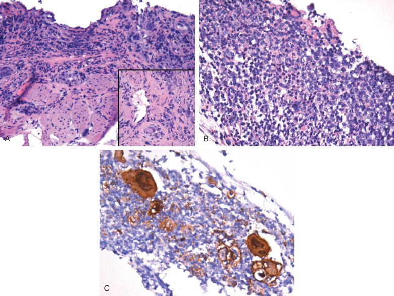 Figure 10.7, Mixed infection in a severely immunocompromised patient.