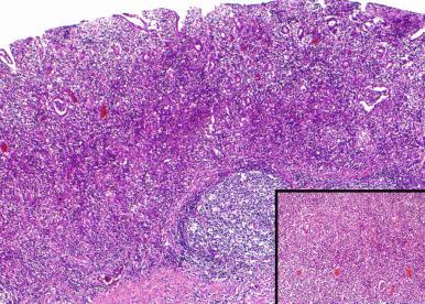 Figure 10.8, Syphilitic involvement of stomach.