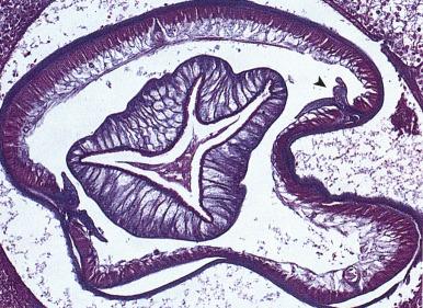 Figure 10.10, Anisakiasis.