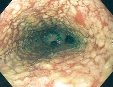 FIG 41.1, Candida esophagitis . Multiple yellow plaques coat the esophageal lumen. In several areas, the plaque has been removed, showing a normal-appearing underlying mucosa.