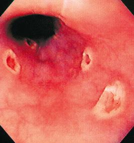 FIG 41.2, Herpes simplex virus esophagitis. There are multiple small ulcers, some of which have a “volcano” appearance typical for herpes simplex virus. The intervening mucosa is normal.