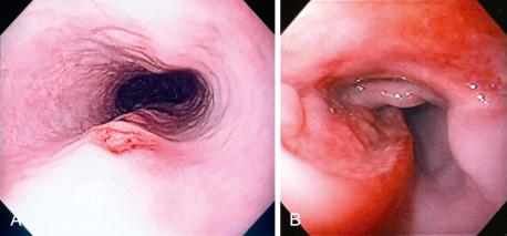 FIG 41.3, Cytomegalovirus esophagitis. A, Two ulcers in the mid-esophagus with normal surrounding mucosa. B, Large hemicircumferential ulcer in the mid-esophagus with heaped-up margins.