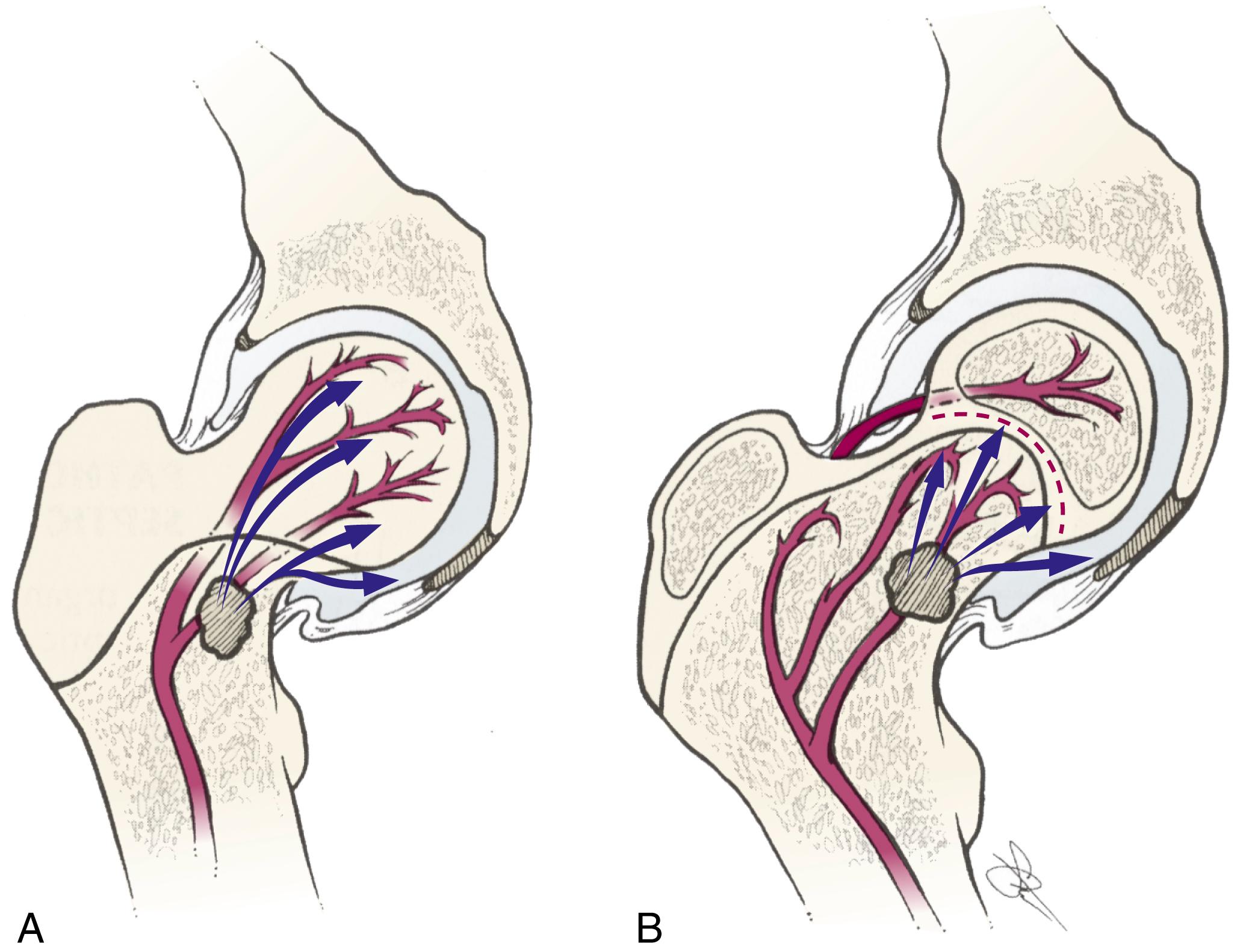 FIG. 23.18, Vascular anatomy of the proximal femur. (A) In the neonate, the entire epiphysis shares a blood supply with the metaphysis. Thus infection in the metaphysis can spread into the epiphysis and can produce devastating osteonecrosis of the proximal femur. (B) After development of the secondary ossification center, the epiphysis and metaphysis have separate blood supplies. Thus in the older child, the physis prevents the spread of infection into the epiphysis. However, the metaphysis remains intraarticular, and infection may decompress into the joint and produce septic arthritis.
