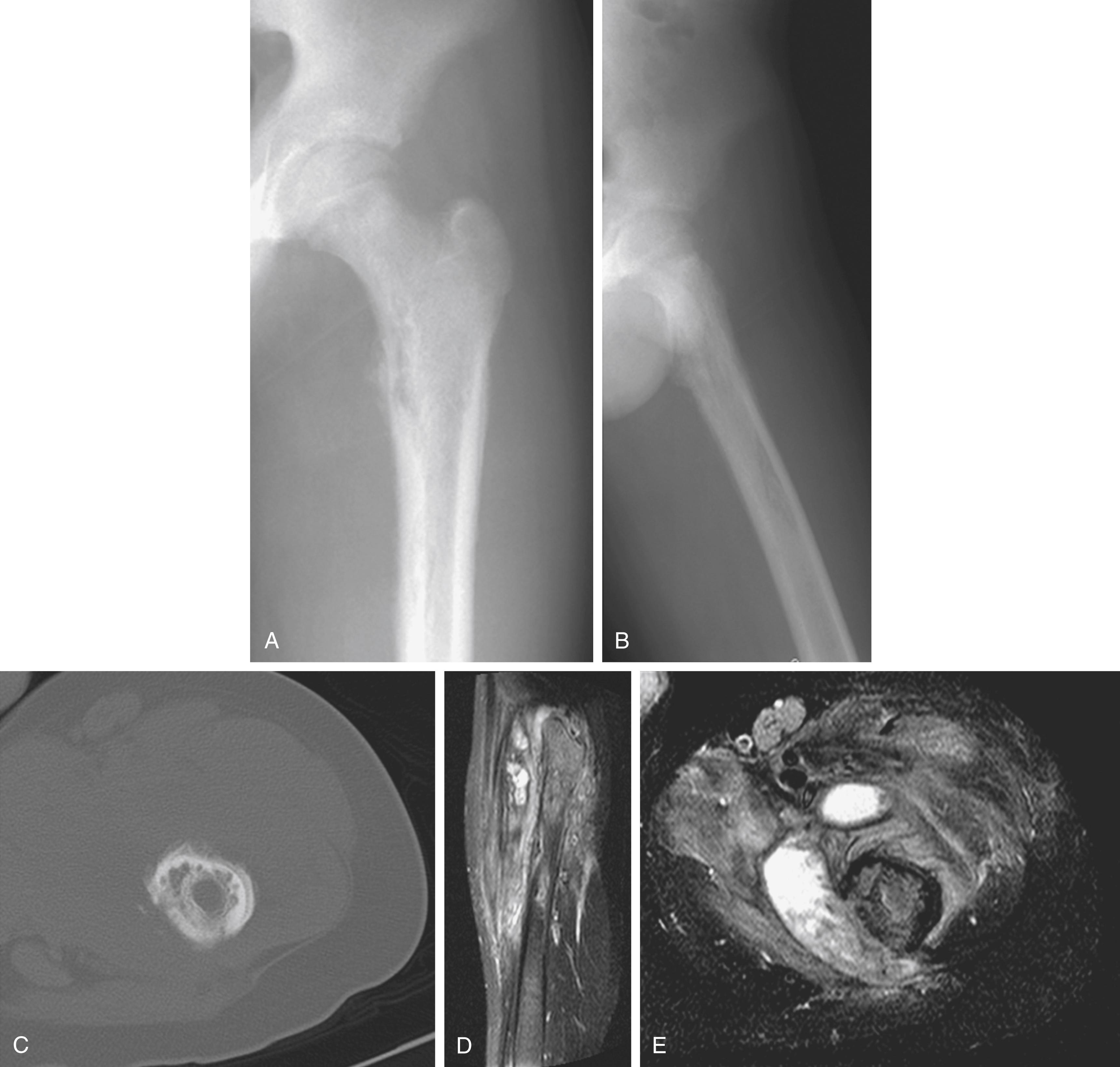 FIG. 23.3, Fifteen-year-old boy with a 20-pound weight loss and nighttime pain in the left hip of 3 months’ duration. (A and B) Plain radiographs show poorly permeative lytic changes in the left proximal femur. (C) Computed tomography scan of the area of involvement demonstrates permeative cortical erosions with periosteal reaction. (D and E) Magnetic resonance images show diffuse femoral marrow signal changes with a fluid collection adjacent to bone suggestive of abscess rather than liquefied tumor necrosis. Biopsy and culture confirmed the diagnosis of subacute osteomyelitis with methicillin-resistant Staphylococcus aureus.