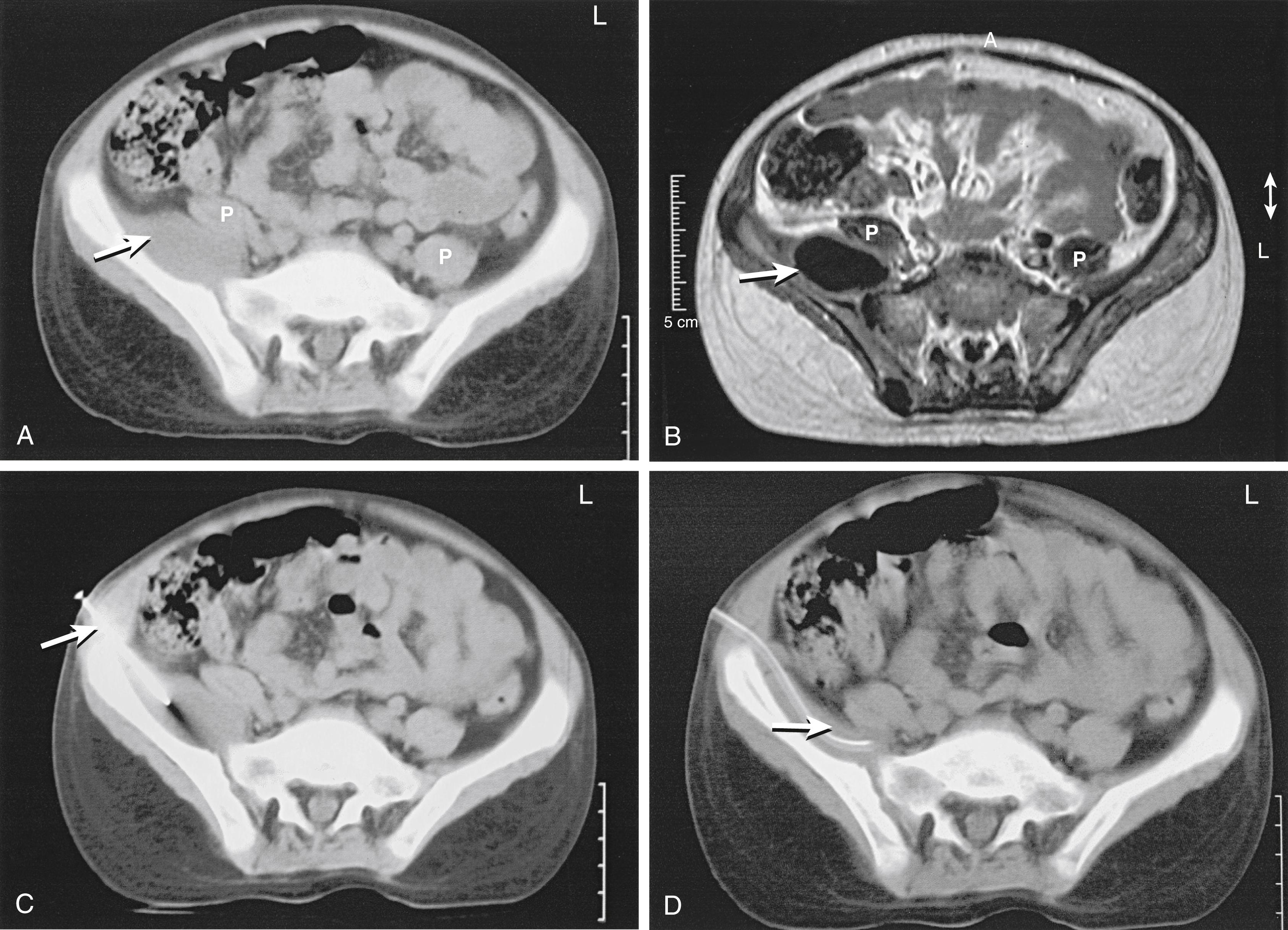 FIG. 23.8, Computed tomography (CT) scan (A) and magnetic resonance image (B) demonstrating a psoas abscess (arrows) displacing the right psoas muscle (P) . CT-guided percutaneous drainage (C) was performed, with placement of a drainage tube (D).