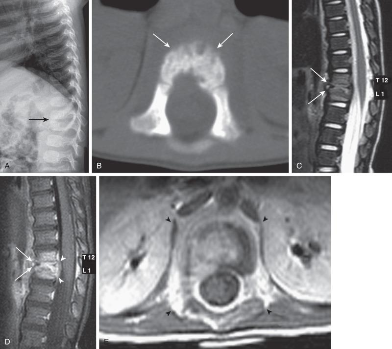 Figure 44.7, Discitis/Osteomyelitis.