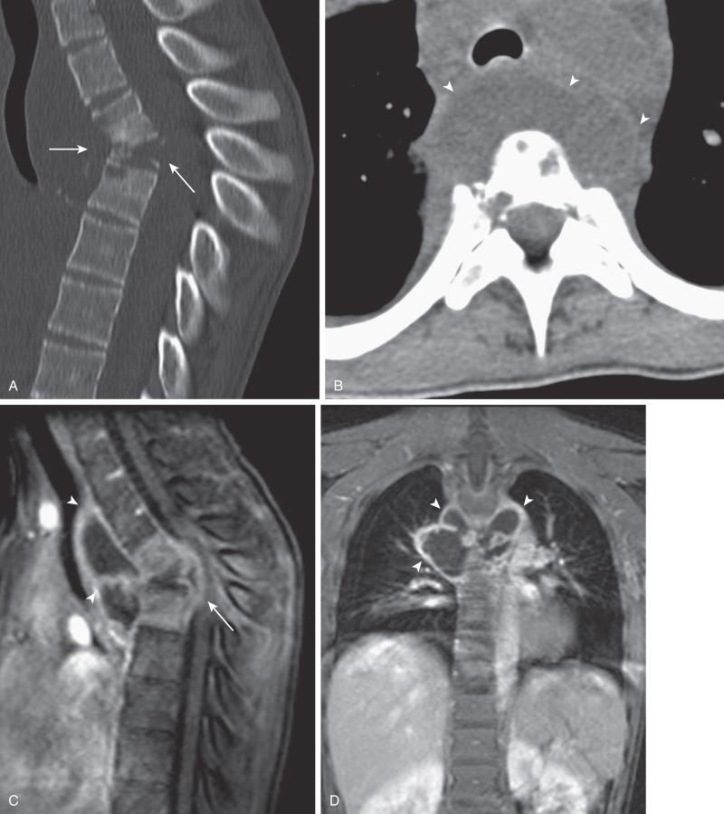 Figure 44.8, Tuberculous osteomyelitis in 13-year-old female with progressive loss of strength and coordination in legs.