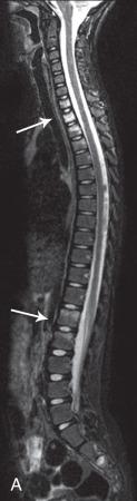 Figure 44.9, Chronic recurrent multifocal osteomyelitis.