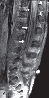 Figure 44.10, Guillain-Barré Syndrome.