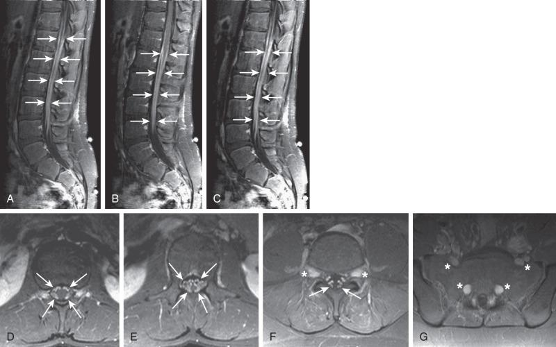 e-Figure 44.11, Chronic inflammatory demyelinating polyneuropathy (CIDP).