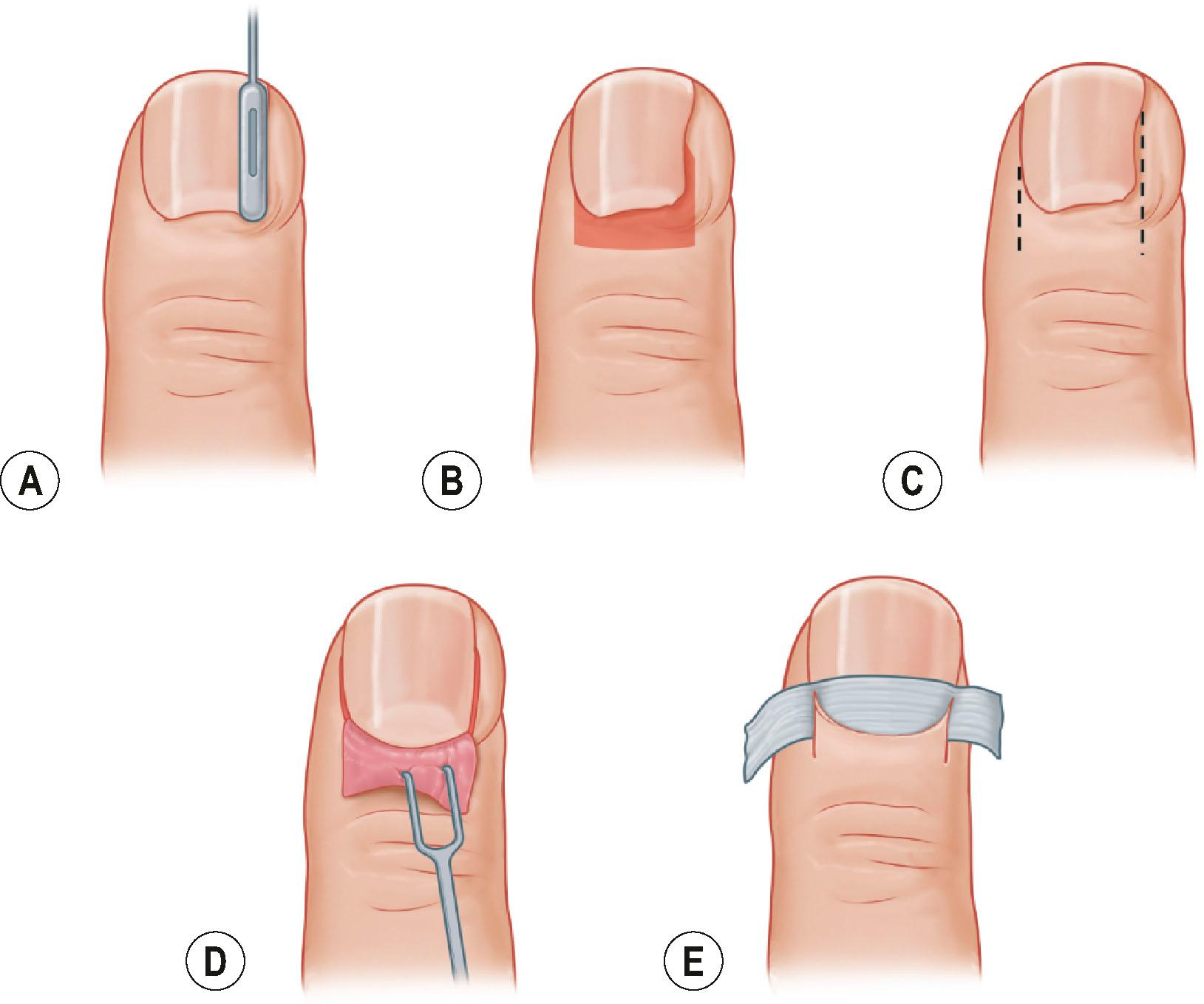 Figure 15.2, Incisions for drainage of paronychia. (A) The nail plate and eponychial fold are elevated with a Freer elevator. (B) A skin incision is placed parallel to the lateral nail fold to drain the paronychia. (C) If proximal extension is needed, the incision can be carried from the corner of the nail fold and extended laterally at an angle. (D) A second skin incision can be performed to adequately drain the paronychia. (E) Wicking the incision site with gauze is recommended to prevent premature closure and re-collection of pus.