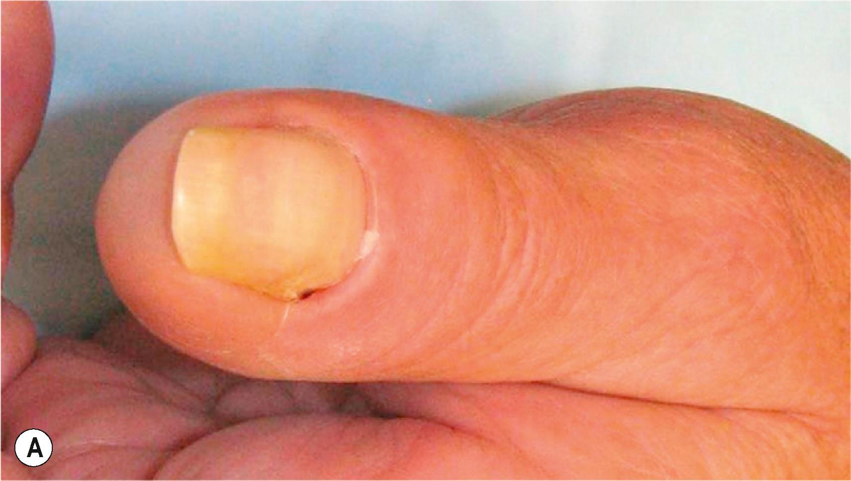 Figure 15.3, Chronic paronychia involving the thumb. (A) Dorsal view showing thickened, indurated, and erythematous tissue proximal to the nail plate. The nail plate is also thickened and discolored. (B) Lateral view demonstrates retraction of the eponychial fold.