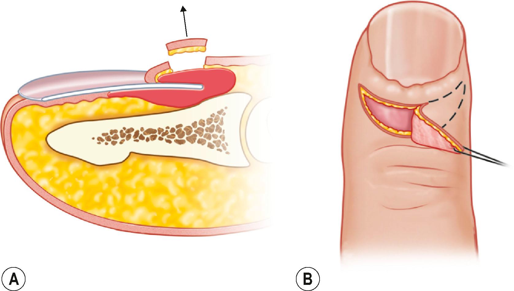 Figure 15.4, Eponychial marsupialization for chronic paronychia. (A,B) A 3-mm-wide crescent-shaped excision of skin is performed to the depth of the germinal matrix. The germinal matrix is maintained and unharmed.