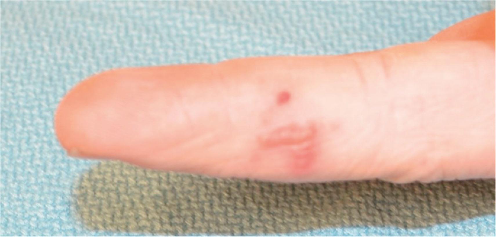 Figure 15.5, Herpetic whitlow. Clinical signs include 1–3-mm grouped vesicles present along the digital neurovascular bundles.