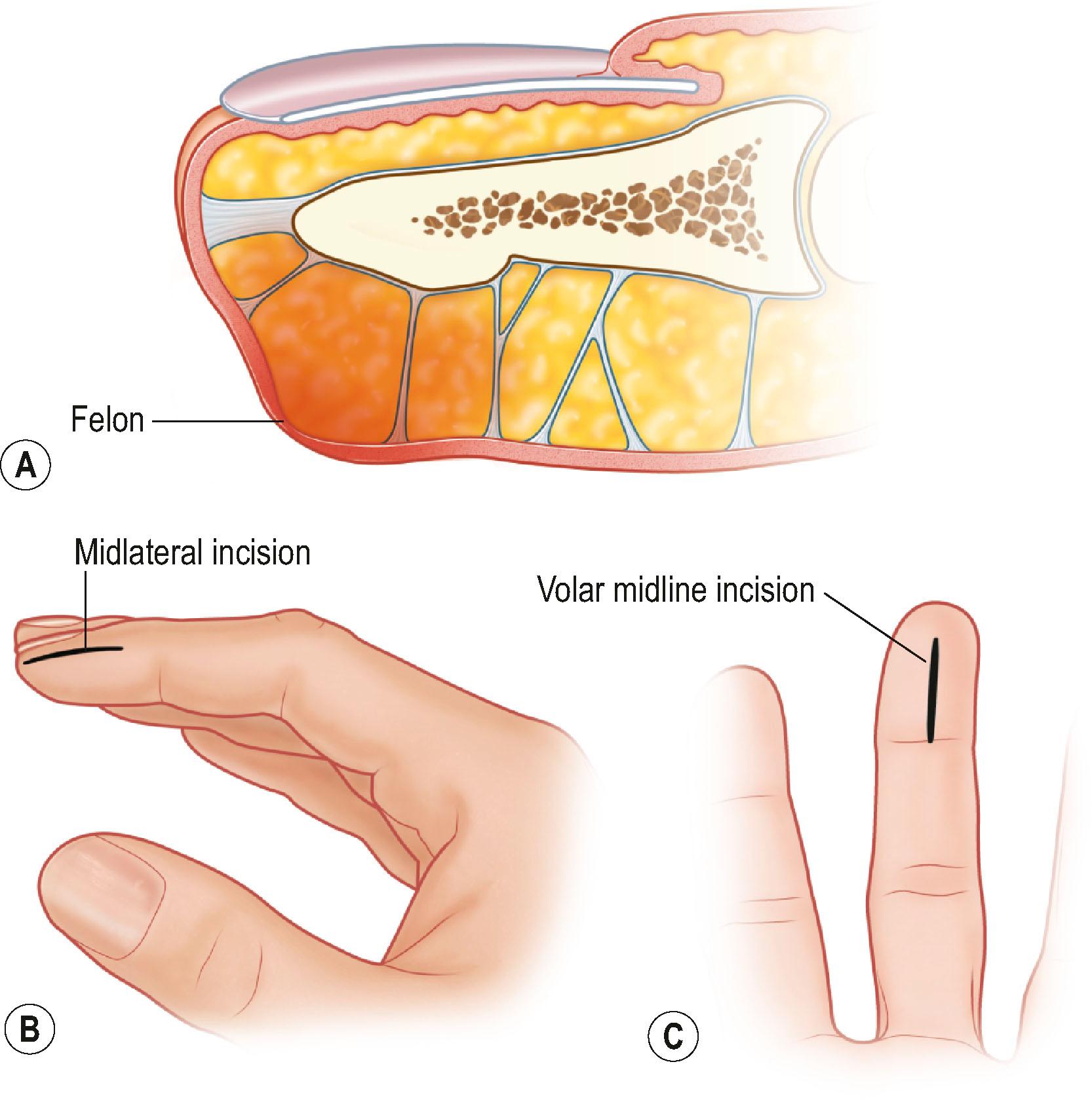 Figure 15.7, Incisions for felon drainage. (A) Cross-section of the distal fingertip, showing inflammation and collection of fluid within the septa. (B) A unilateral midlateral incision allows access to the septations of the distal pulp. Care needs to be taken to avoid the neurovascular bundles. (C) A single volar incision can be used. This approach has less risk to the digital neurovascular bundles. To avoid scar contracture, the incision should not pass the flexion crease.