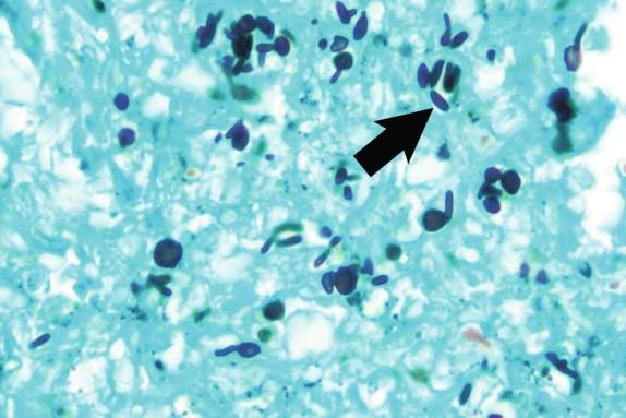 Figure 26-11, The GMS stain highlights the numerous yeasts in the tissue. Round to oval forms are present, as well as the classic “cigar body” (arrow). GMS stain, 500 × magnification.