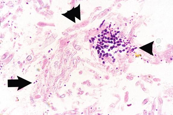 Figure 26-13, The biopsy from this severely immunocompromised patient contained three fungi, C. glabrata (arrow), C. tropicalis (arrowhead), and the ribbon-like hyphae of a zygomycete (double arrowhead). This demonstrates the size difference between C. glabrata and non- C. glabrata species. H&E stain, 500 × magnification.