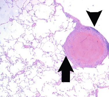 Figure 26-3, The old, inactive histoplasmoma in the lung demonstrates central necrosis and a peripheral ring of fibrous tissue (arrow) that has replaced the active granulomatous inflammation (i.e., the active macrophages). Peripheral cuffs of lymphocytes are common, as present here (arrowhead). H&E stain, 100 × magnification.