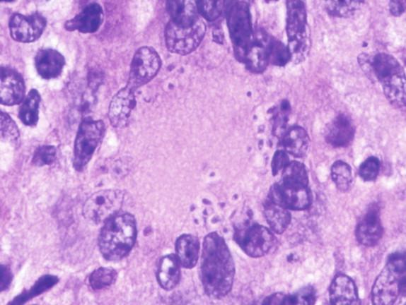 Figure 26-4, The giant cell present in this biopsy has phagocytosed many Histoplasma yeasts. The clearing around the yeasts led early observers to believe this was a parasite or an encapsulated organism, whereas it is actually a retraction artifact in combination with the poorly staining cell wall. H&E stain, 1000 × magnification.