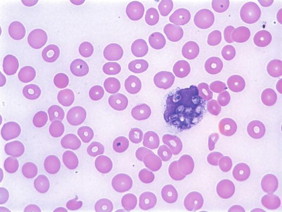 Figure 26-5, This phagocyte detected in the standard peripheral blood smear contains many yeasts of H. capsulatum. Giemsa stain, 500 × magnification.