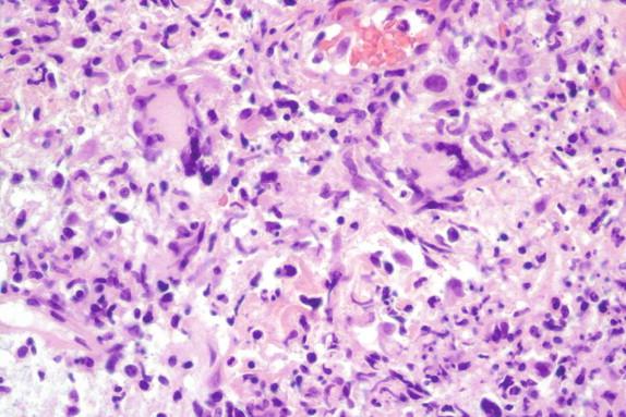 Figure 26-10, This area from a skin biopsy of a patient with sporotrichosis demonstrates predominantly non-necrotizing granulomas, although an infiltration of neutrophils is seen in the lower right. The numerous yeast forms in the tissue are not appreciated in the H&E-stained section (see Figure 26-11 ). H&E stain, 400 × magnification.