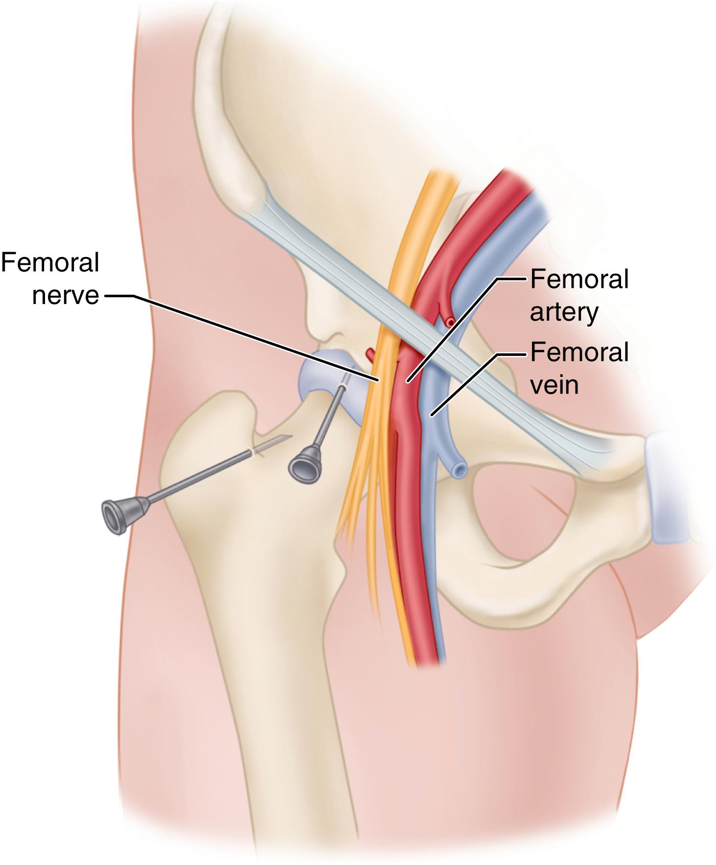 FIGURE 22.5, Aspiration of hip, two approaches. SEE TECHNIQUES 22.11 AND 22.12 .