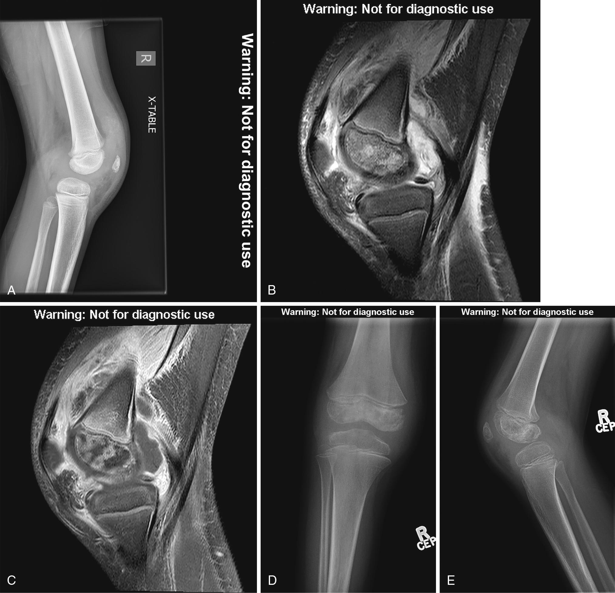 Fig. 44.1, A, Lateral view of the right knee in a 6-year-old boy with pain and fever demonstrates a large joint effusion. Magnetic resonance imaging (MRI) obtained a few days later confirms a large joint effusion with diffuse synovial thickening on the sagittal short tau inversion recovery (STIR) image ( B ). The sagittal T1 fat-saturated image post-gadolinium ( C ) shows avid enhancement of the thickened synovium with nonenhancing pockets of fluid. There is also abnormal enhancement of the distal femoral epiphysis in keeping with osteomyelitis with bone abscess ( arrow ). Anteroposterior (AP) ( D ) and lateral ( E ) radiographs of the right knee after treatment show resolution of the joint effusion with patchy sclerosis in the distal femoral epiphysis indicating ongoing healing from osteomyelitis.