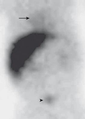 Figure 90.1, Hepatitis in a 7-week-old boy with persistent jaundice.