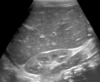 Figure 90.2, Hepatitis B in a 5-month-old boy with persistent elevation of liver function tests.