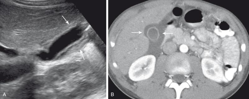 Figure 90.3, Gallbladder wall thickening in a 10-year-old boy with viral hepatitis.