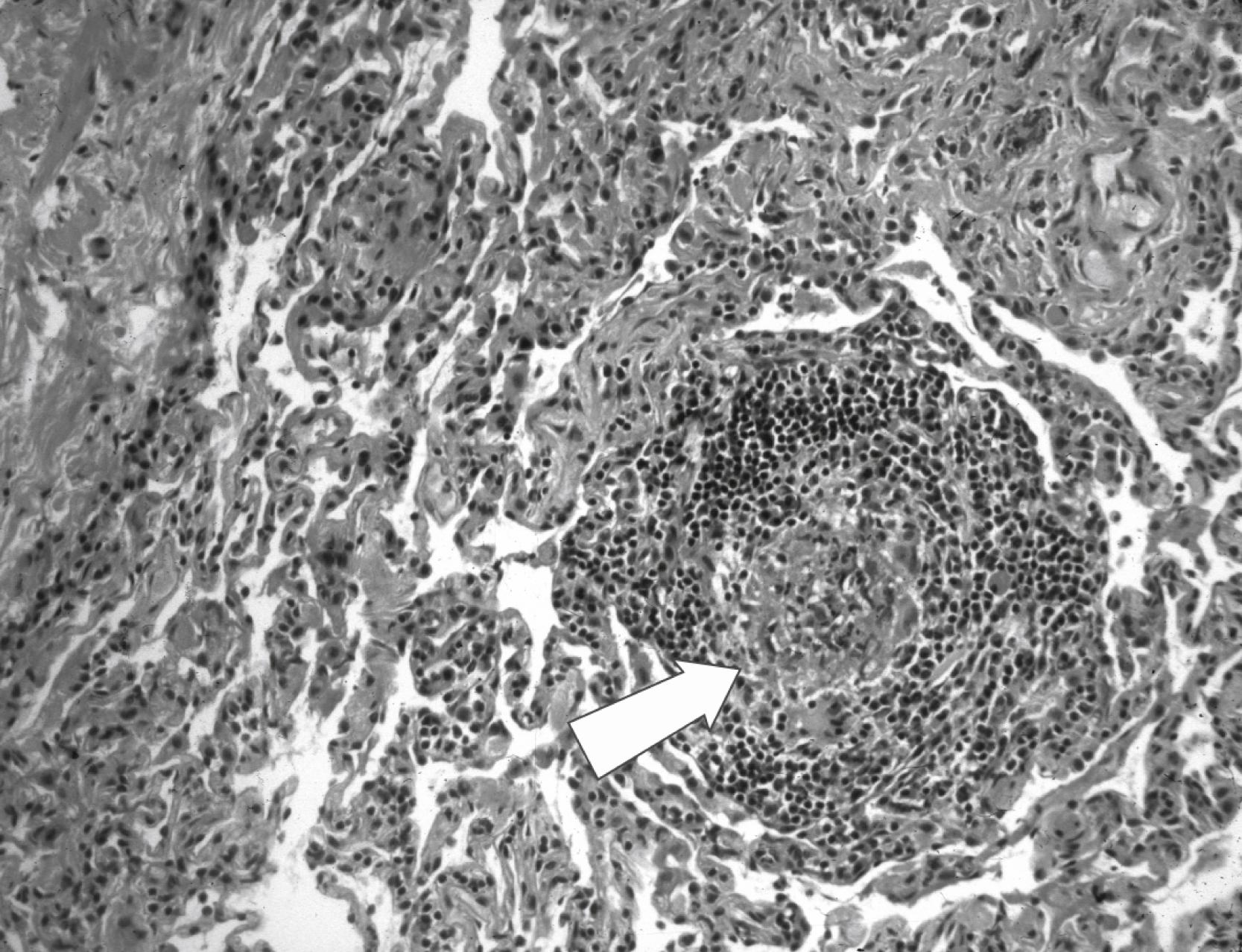 FIGURE 104.1, Pyogranuloma (acute inflammatory cells within granulomatous inflammatory response) (arrow) in the lung of patient with chronic granulomatous disease and Aspergillus spp. pneumonia.