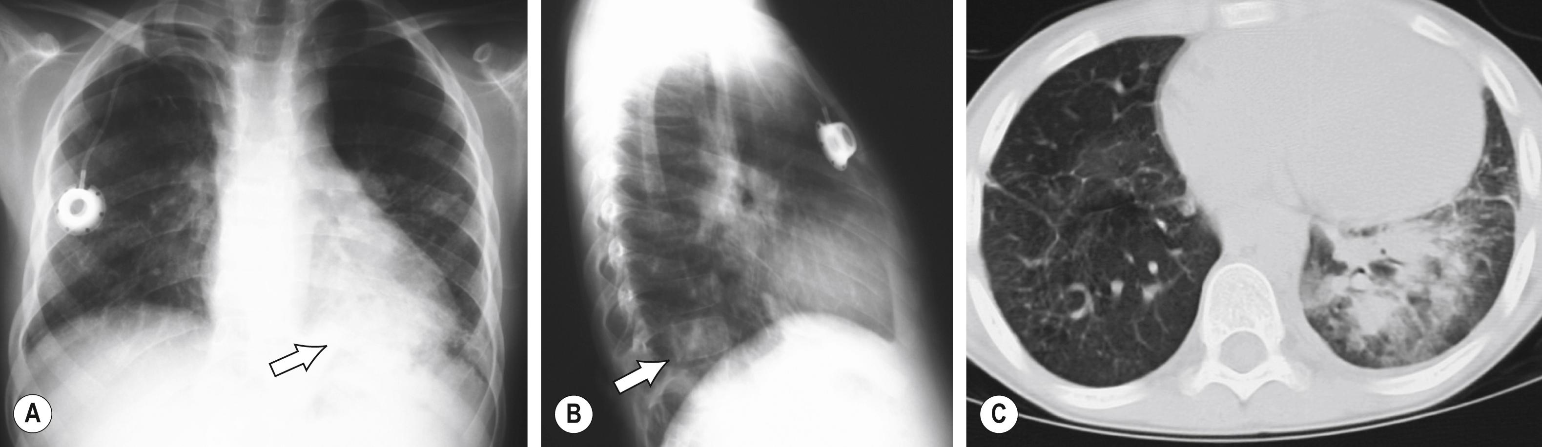 FIGURE 104.2, Chest radiograph and chest CT scan of a 7-year-old child with chronic granulomatous disease with fever and dry cough. Plain films show a retrocardiac left lower lobe infiltrate (arrow) (A), which appears small on the lateral view (arrow) (B). (C) CT demonstrated more extensive disease throughout the left lower lobe. Burkholderia cepacia was isolated from the open-lung biopsy. Because this child had an episode of pneumonia caused by the same organism 12 months previously, the exposure history was more intensively examined, revealing that the child had a favorite outdoor activity of pulling up wild onions.