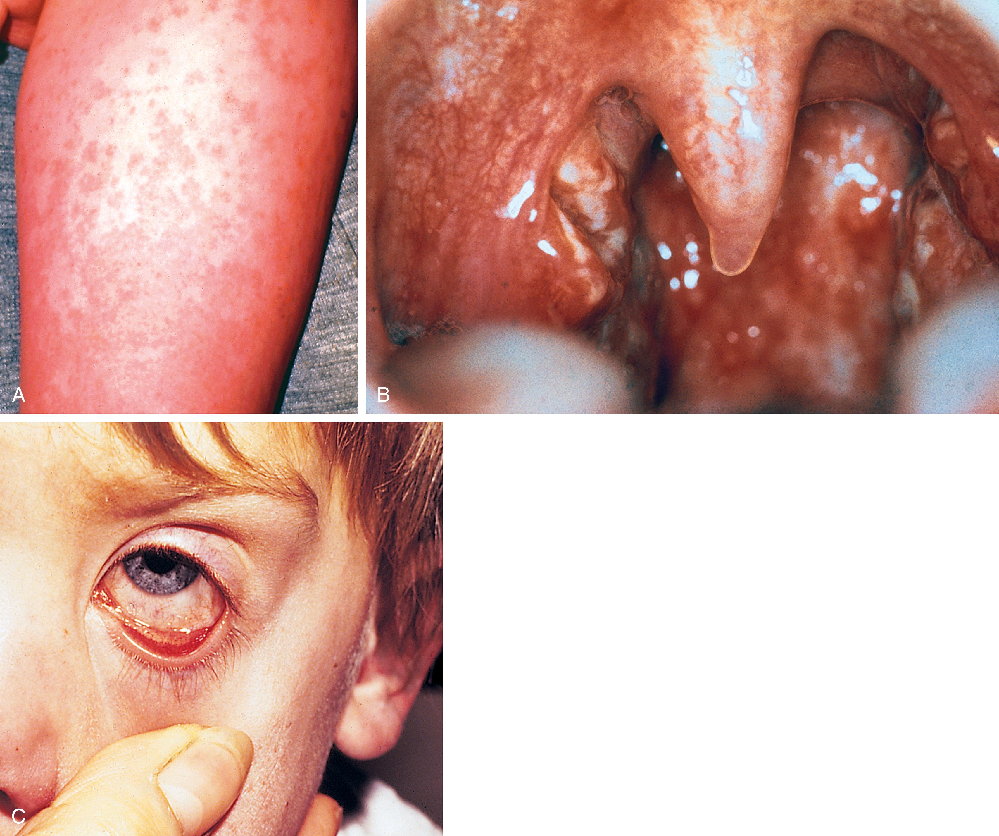Fig. 13.1, Adenovirus. (A) This discrete, erythematous, blanching maculopapular rash was generalized when first noted and occurred in association with pharyngitis (B) and a nonpurulent conjunctivitis (C).