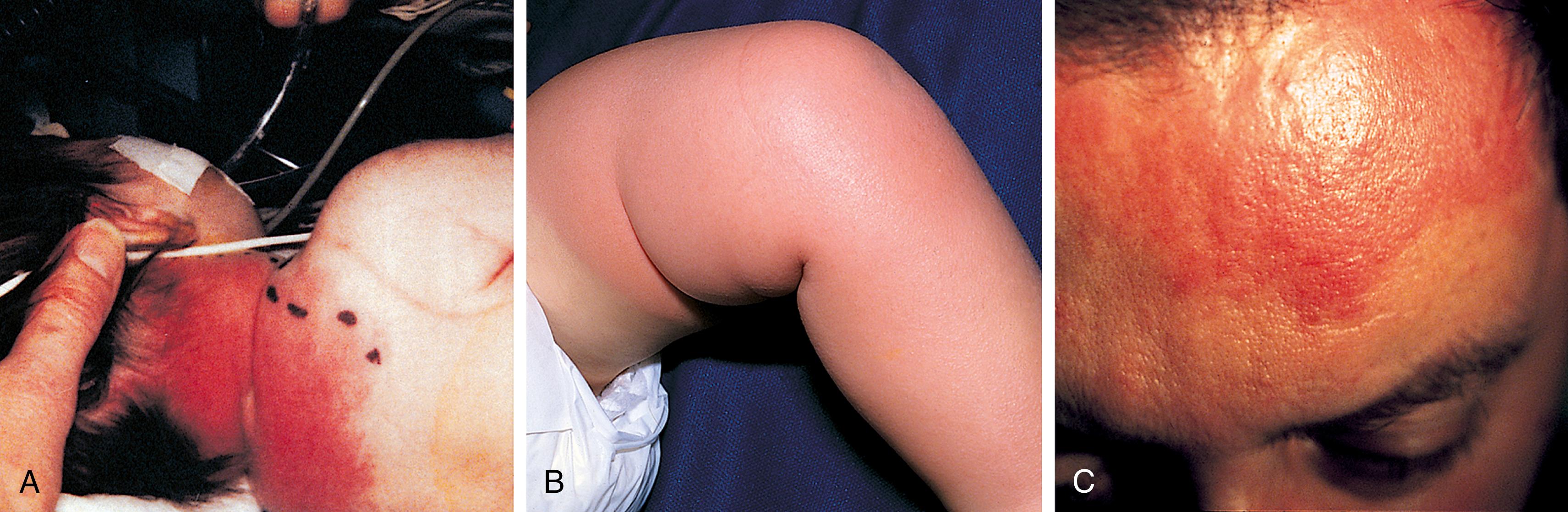 Fig. 13.32, Erysipelas. (A) This 6-week-old infant had fever, lethargy, irritability, and hypotension in association with erysipelas. The purplish-red lesion was raised, indurated, and tender. The border, although irregular, was sharply demarcated from the adjacent skin. Cultures of blood and tissue aspirate grew Group A streptococci. (B) The sharply circumscribed area of erysipelas on this toddler’s leg was pink. On close inspection, one can see that the skin has a peau d’orange quality. (C) This is seen more clearly in a close-up of an adolescent’s forehead.