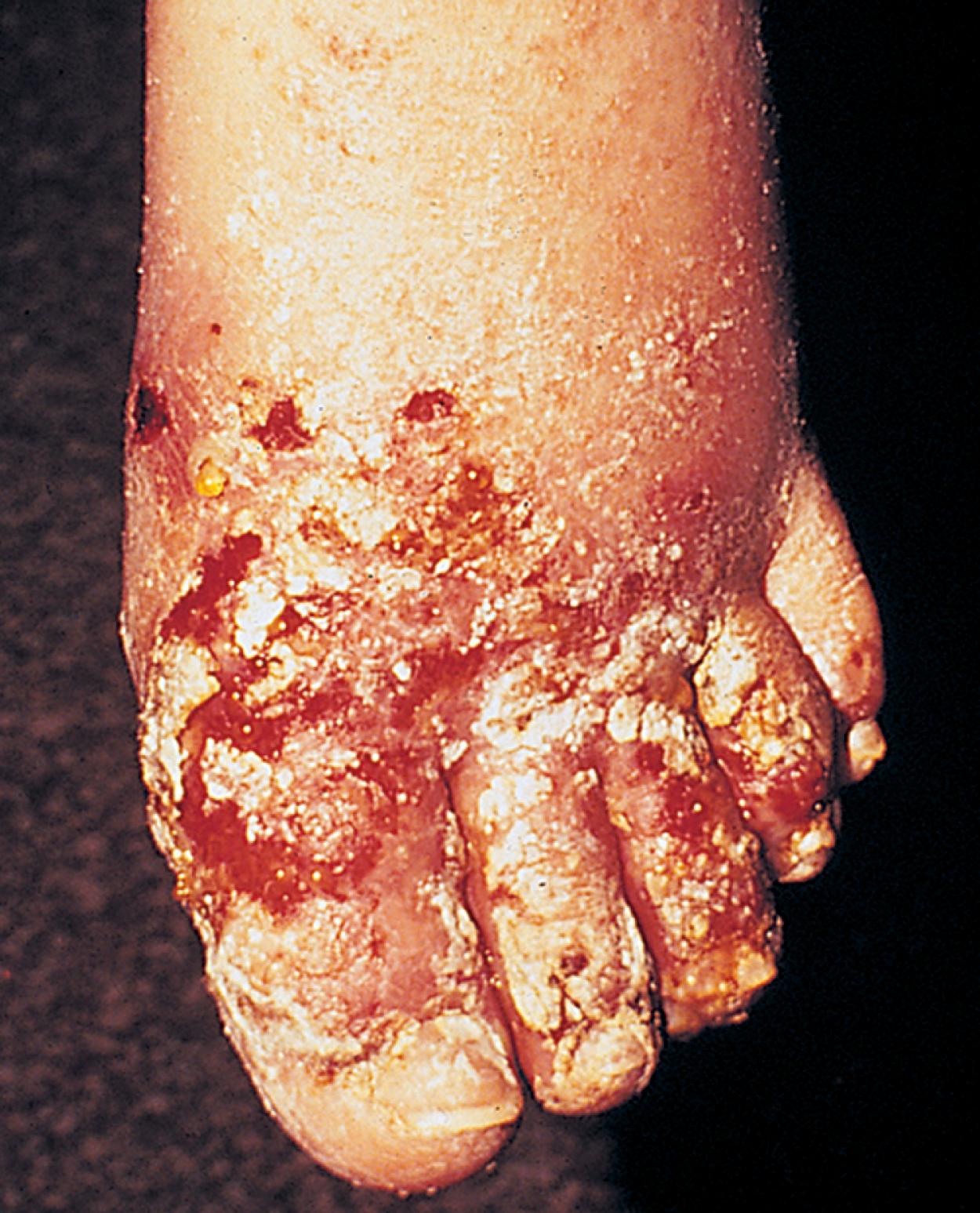 Fig. 13.34, This patient with cellulitis of the foot had been receiving topical steroid therapy for contact dermatitis for about 48 hours when he experienced the explosive onset of swelling, redness, and pain. Impetiginous changes are apparent as well.