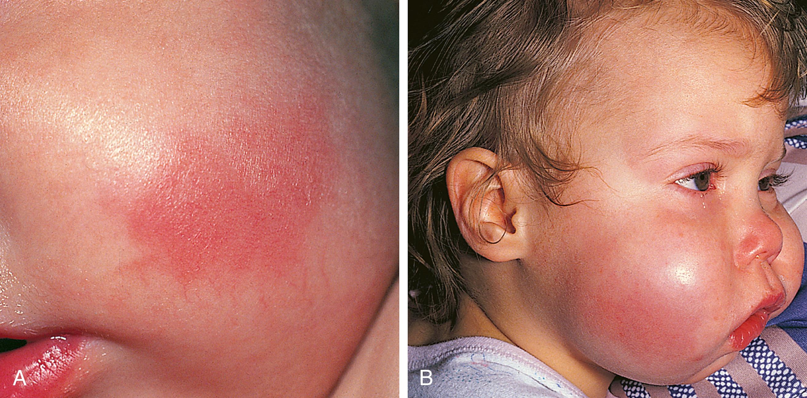 Fig. 13.35, Hematogenous cellulitis. (A) A small erythematous patch with indistinct borders appeared on this infant’s cheek shortly after the onset of fever, irritability, and anorexia. On palpation it was found to be indurated and tender. Blood culture was positive for Haemophilus influenzae type B. (B) In this toddler, the evolution of buccal cellulitis due to H. influenzae was fulminant, resulting in unusually dramatic swelling.