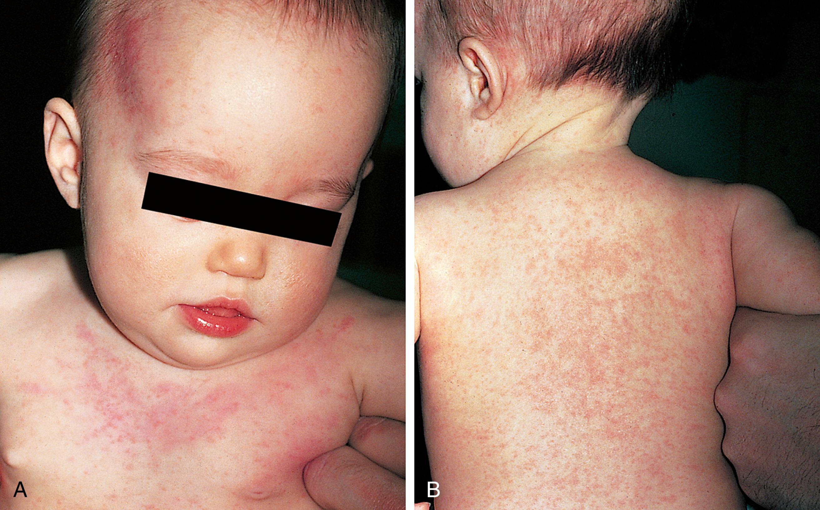 Fig. 13.11, Roseola infantum/exanthem subitum. (A and B) The exanthem of this disorder usually appears abruptly after 3 days of high fever and irritability. It is characterized by discrete, rose-pink macules. It may be generalized at first or may start centrally and spread centrifugally. Scalp involvement is prominent.