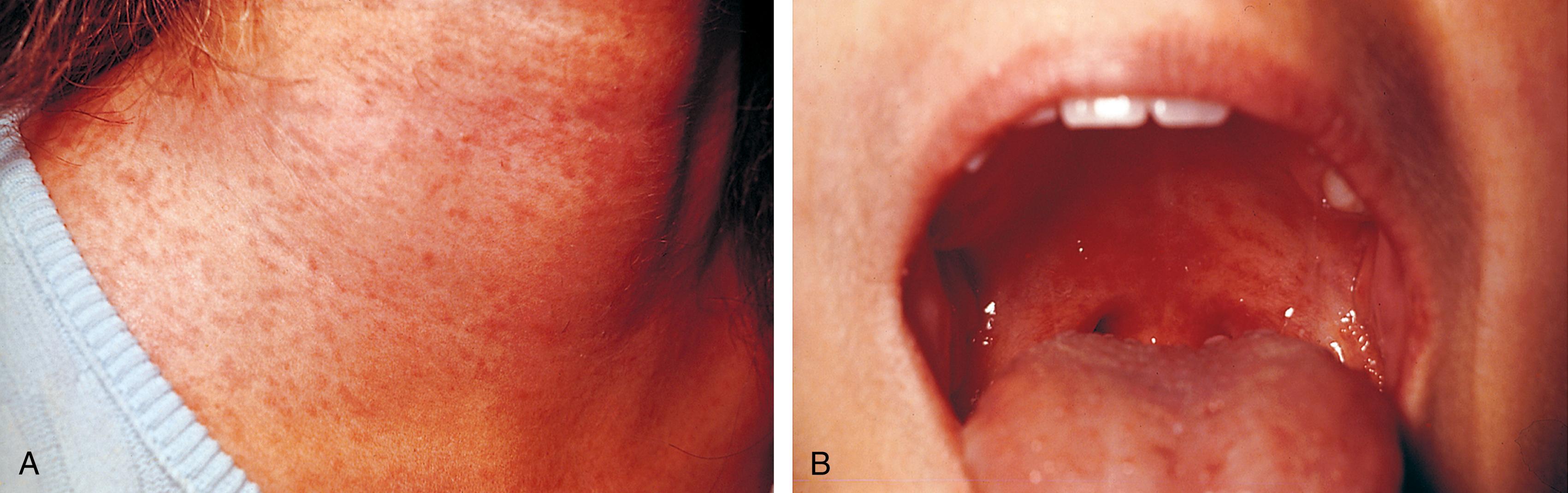 Fig. 13.12, Rubella/German measles. (A) The exanthem of rubella usually consists of a fine, pinkish red, maculopapular eruption that appears first at the hairline and rapidly spreads cephalocaudally. Lesions tend to remain discrete. (B) The presence of red palatal lesions (Forchheimer spots), seen in some patients on day 1 of the rash, and occipital and posterior cervical adenopathy are findings suggestive of rubella.