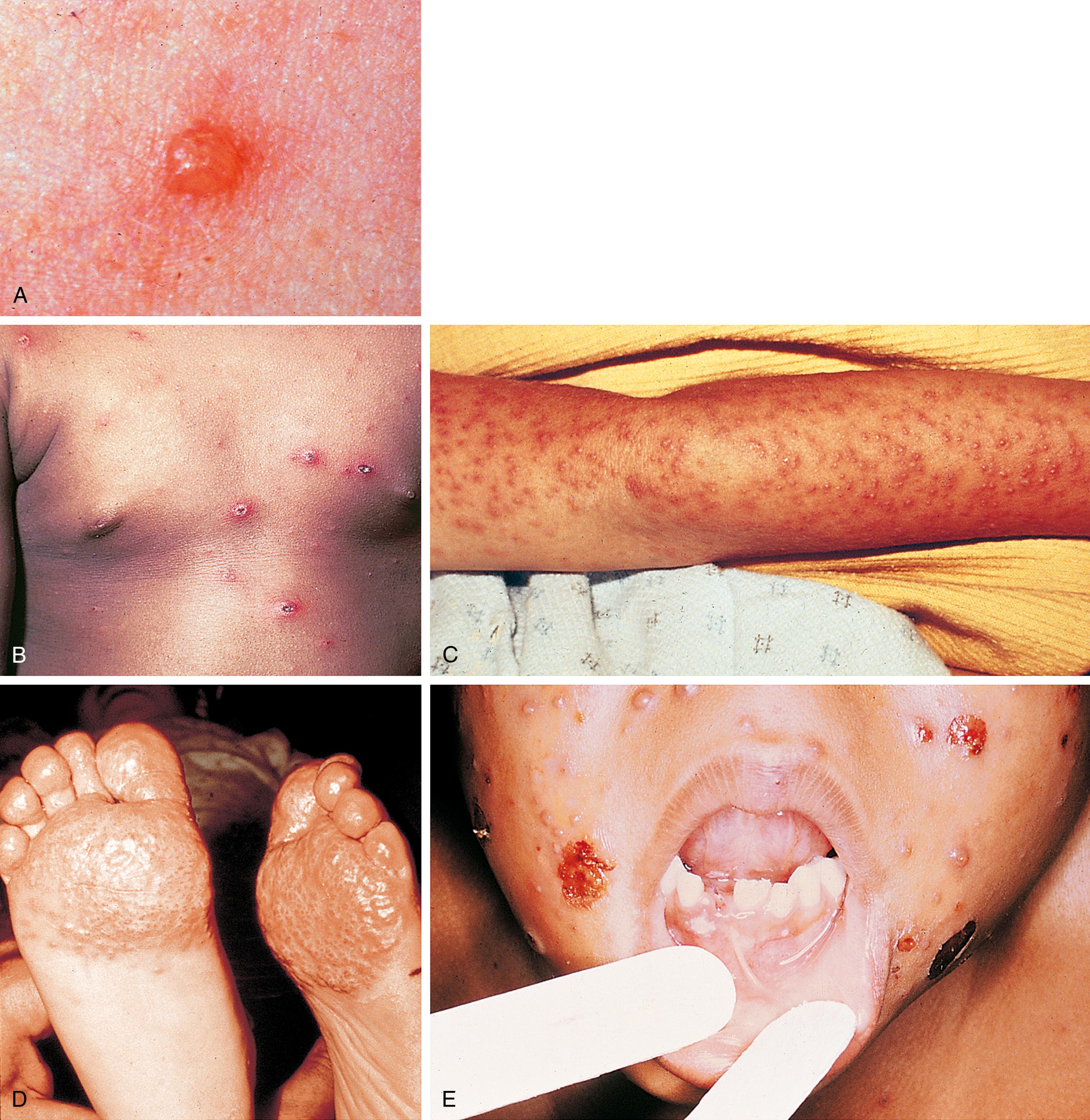 Fig. 13.13, Varicella/chickenpox. (A) The characteristic “dewdrop on a rose petal” is illustrated by this early vesicle on an erythematous base. (B) The typical features of lesions in all stages of evolution are seen on the trunk of this child. Note the presence of papules, vesicles, and umbilicated and scabbed lesions, all within a small area. (C and D) In this child with underlying eczema, the first crop of vesicles appeared in clusters at sites previously affected by dermatitis. The flexor surface of his arm is covered with numerous discrete lesions, and vesicles are confluent over the plantar surface of his toes and on the balls of his feet. (E) On mucosal surfaces, thin-walled vesicles may form and rapidly rupture, forming painful shallow ulcers.