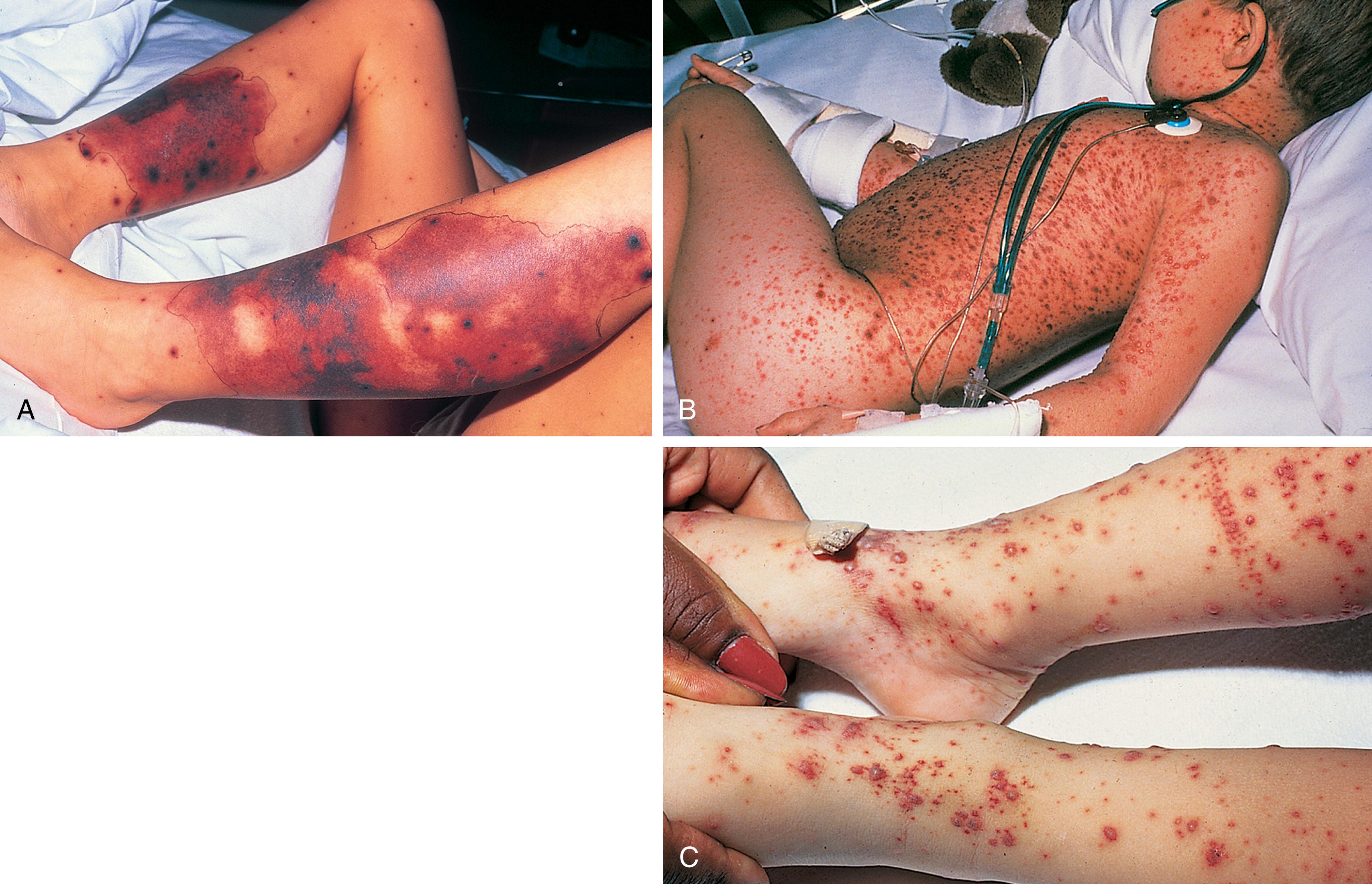 Fig. 13.14, Complications of varicella. (A) Superinfection of this child’s lesions with Streptococcus pyogenes led to purpura fulminans. (B and C) Disseminated hemorrhagic varicella. (B) In the immunocompromised child, skin lesions tend to be hemorrhagic and nearly confluent. (C) Lesions also evolve more slowly than usual, remaining vesicular for a prolonged period.