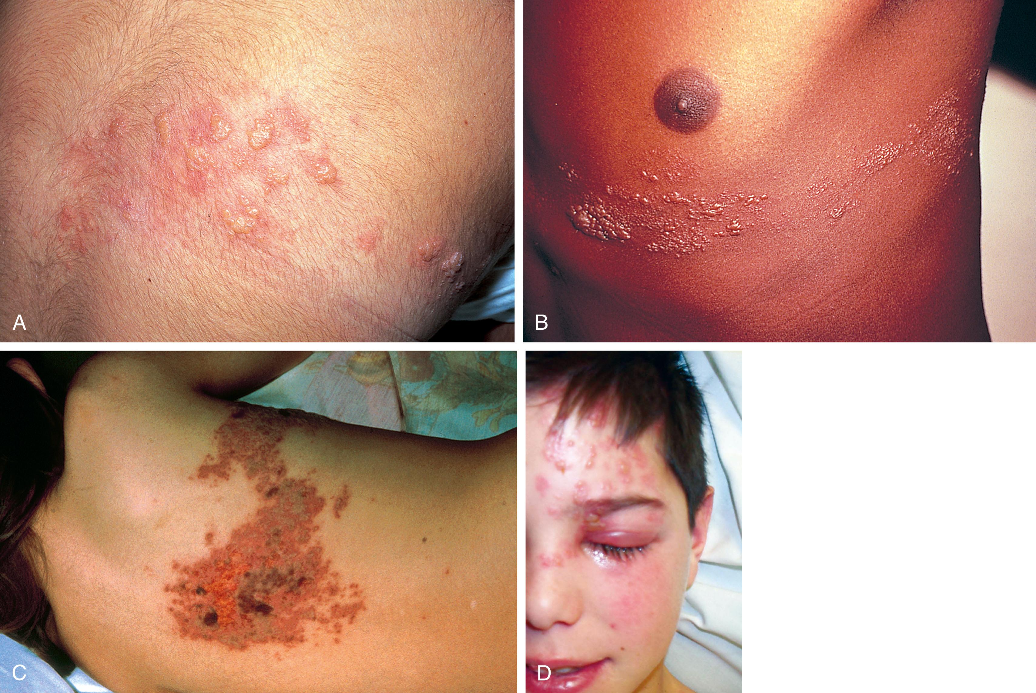 Fig. 13.15, Herpes zoster (shingles). Dermatomal distribution of lesions is a hallmark of herpes zoster. (A) Initially discrete thin-walled vesicles on an erythematous base are seen. Vesicles coalesce over a few days (B), and lesions then evolve to a crusted stage (C). (D) Involvement of the ophthalmic branch of the trigeminal nerve produces lesions involving the forehead, eyelids, and nose.