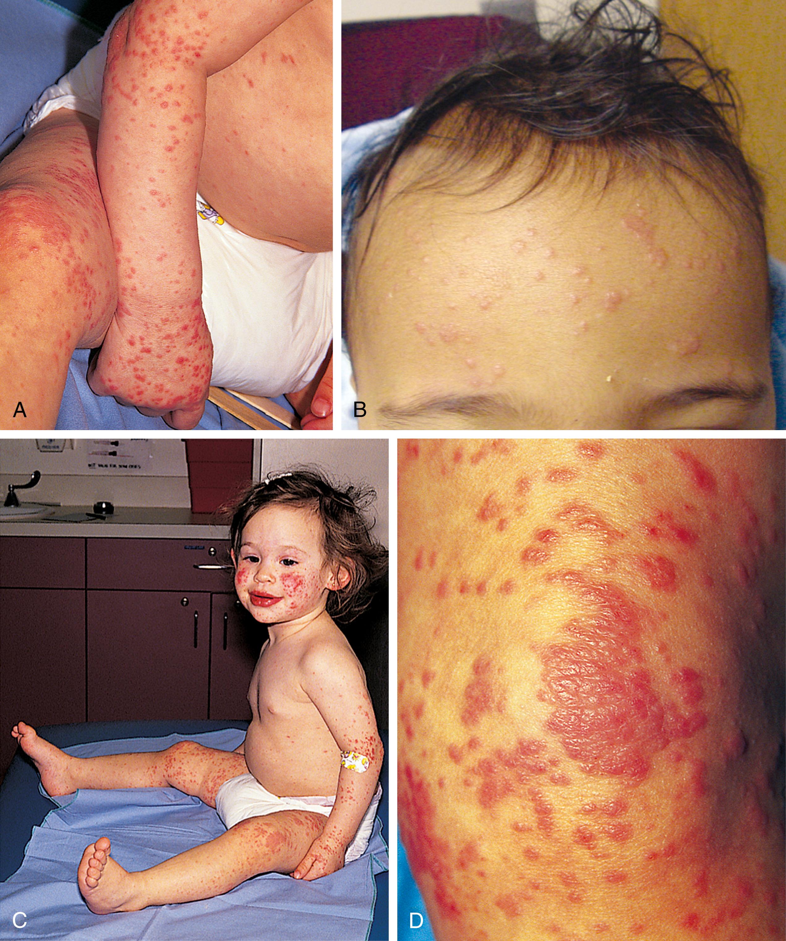 Fig. 13.16, Gianotti-Crosti syndrome. (A and B) Lesions consist of raised lichenoid papules with flat tops that appear in crops and tend to remain discrete. (C) This child shows the characteristic acral distribution, with lesions involving the extremities and face but with relative sparing of the trunk. (D) Lesions can become confluent over pressure points, such as the knee.