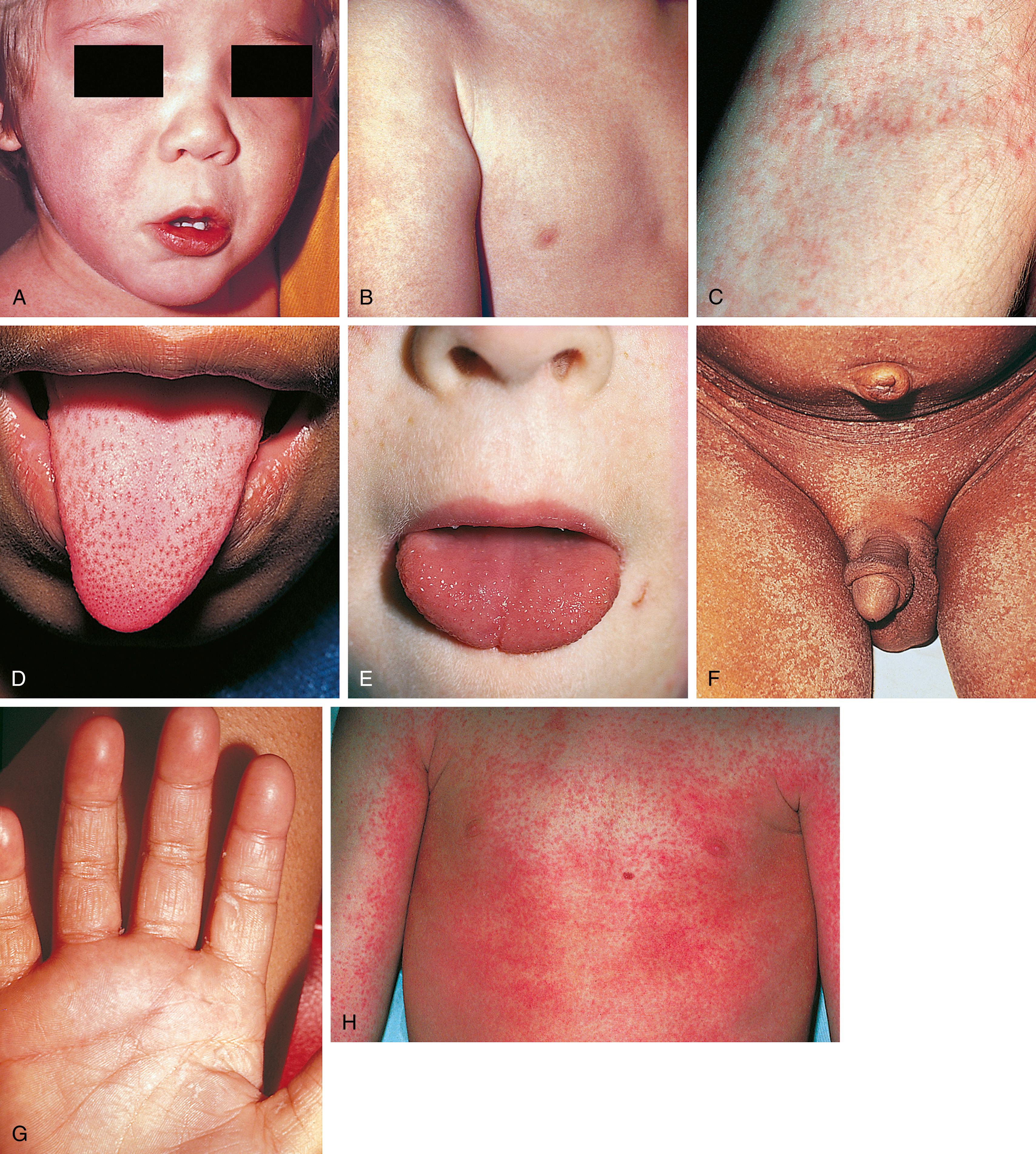 Fig. 13.17, Streptococcal scarlet fever. (A and B) In the classic form of this exanthem, the patient has a flushed face, perioral pallor, and a diffuse, blanching, erythematous rash that has a sandpapery consistency on palpation. (C) Within 1 to 3 days of onset, Pastia lines may be noted. (D) During the first 1 to 2 days the tongue has a white coating through which prominent erythematous papillae project—a white strawberry tongue. (E) A few days later the white coat peels, leaving the characteristic red strawberry tongue with glistening surface and prominent papillae. (F and G) Desquamation occurs in fine, thin flakes as the acute phase of the illness resolves and is proportional to the intensity of the exanthem. (H) A wide spectrum of severity and manifestations exists. In this child with streptococcal scarlet fever, the rash has a patchy distribution but is accentuated in the axillae and other creases.