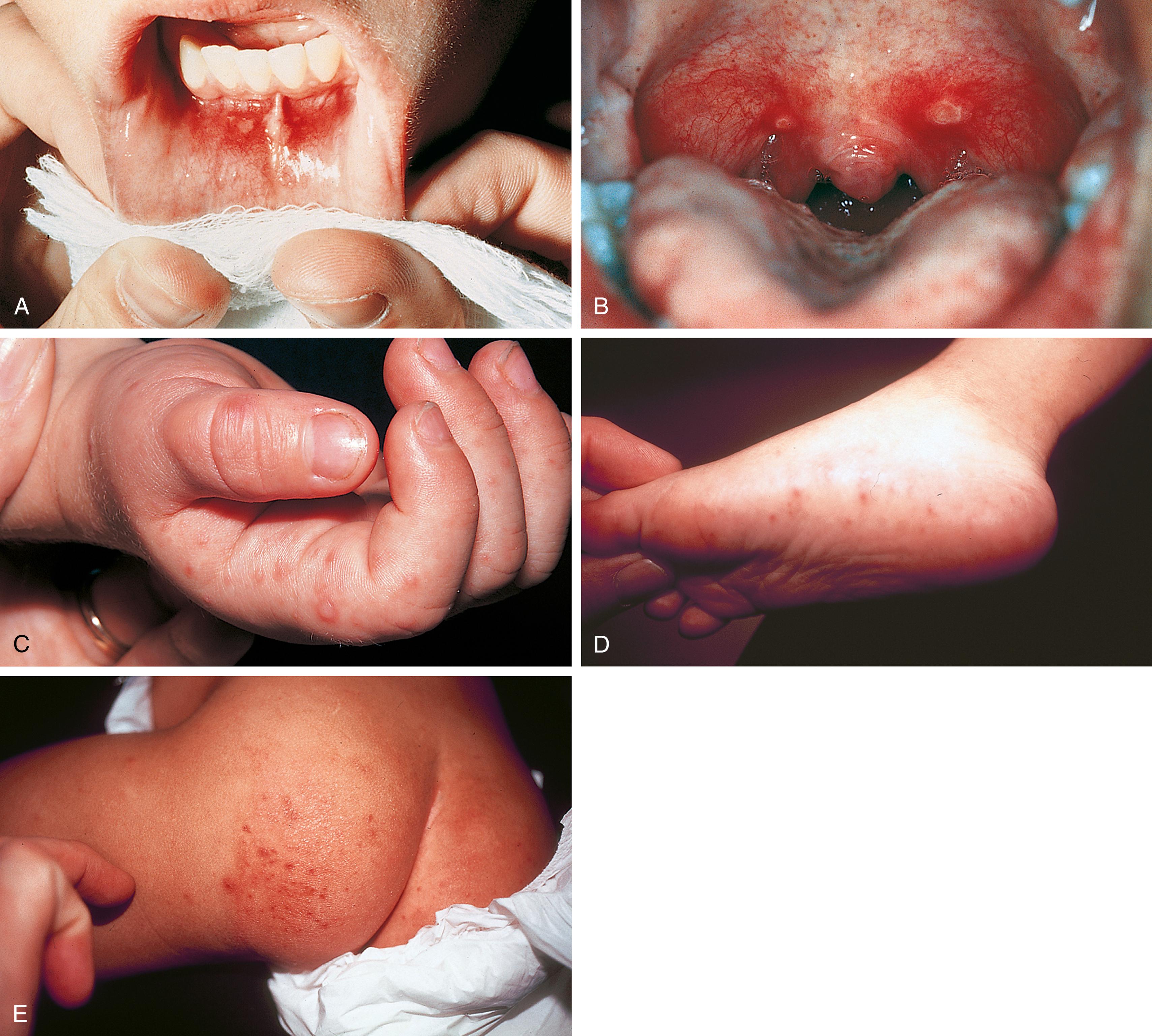 Fig. 13.2, Coxsackievirus hand-foot-and-mouth disease. The enanthem of this disorder is characterized by mildly painful, shallow, yellow ulcers surrounded by red halos. These may be found on the labial or buccal mucosa (A), tongue, soft palate (B), uvula, and anterior tonsillar pillars. When oral lesions occur in the absence of the exanthem, the resulting disorder is called herpangina. (C and D) The exanthem of coxsackievirus hand-foot-and-mouth disease involves the palmar, plantar, and interdigital surfaces of the hands and feet and sometimes the buttocks (E). It consists of thick-walled, gray vesicles on an erythematous base.