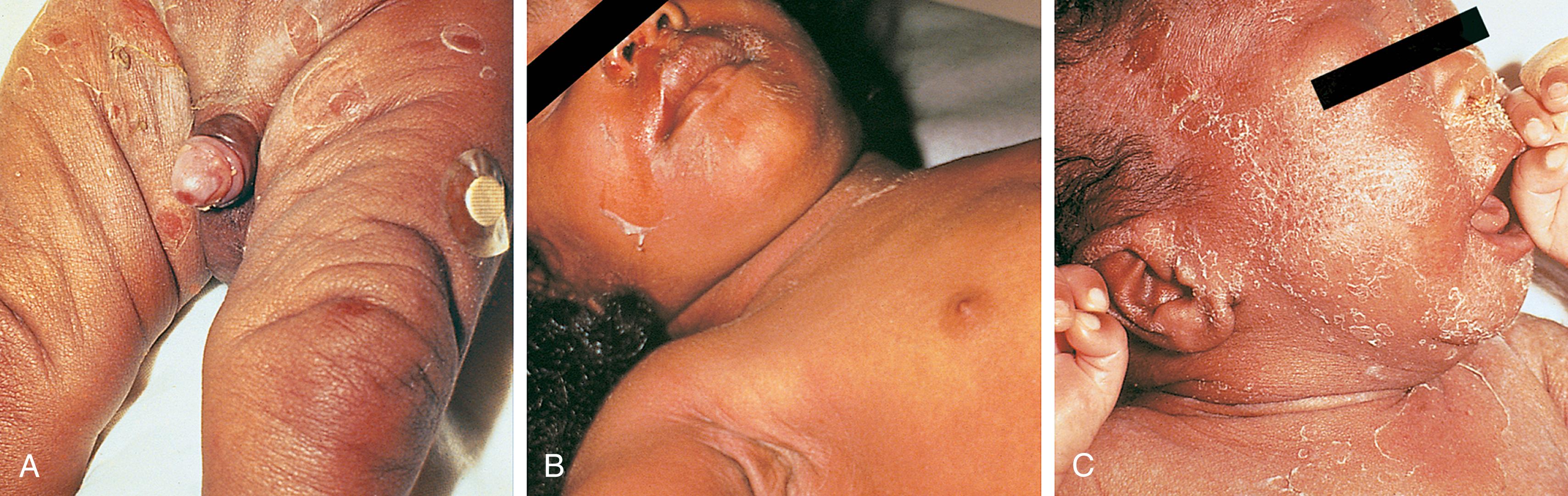 Fig. 13.18, Staphylococcal scalded skin syndrome. (A) This infant shows evidence of epidermal separation and has numerous ruptured bullae over the inguinal region and thighs. (B) In this older child, symptoms were mild and only the skin of the face, axillae, and perineum showed signs of epidermal separation. Note the evidence of a positive Nikolsky sign on her upper lip and cheek, the result of wiping her nose. (C) A denuded area is evident on the upper chest, and thick flakes have begun to form on the face of this infant. Culture of the purulent nasal discharge was positive for Staphylococcus aureus.