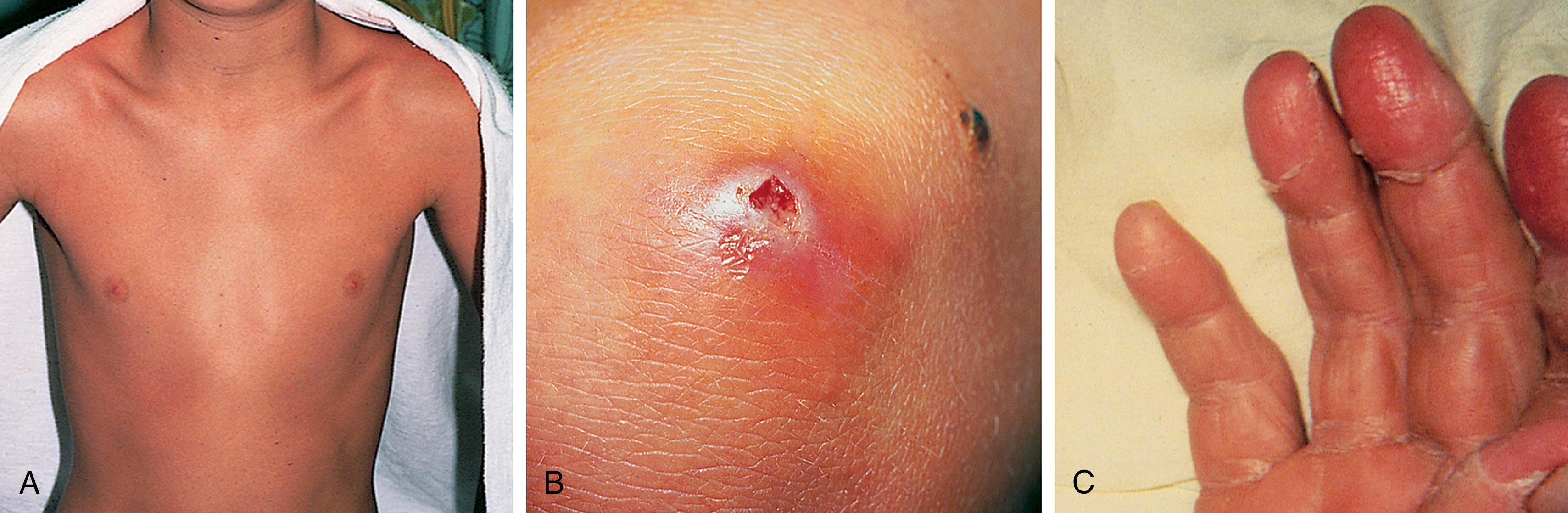 Fig. 13.20, Toxic shock syndrome (TSS). (A) This young boy presented with diffuse erythroderma, fever, chills, myalgias, headache, vomiting, and orthostatic dizziness with mild widening of his pulse pressure. (B) Examination disclosed an infected puncture wound of the knee, which grew Staphylococcus aureus. Although his illness was relatively mild, the association of gastrointestinal symptoms and orthostatic changes suggested TSS, which was confirmed by laboratory studies and by subsequent desquamation (C). This begins periungually, and the skin is shed in thick casts.