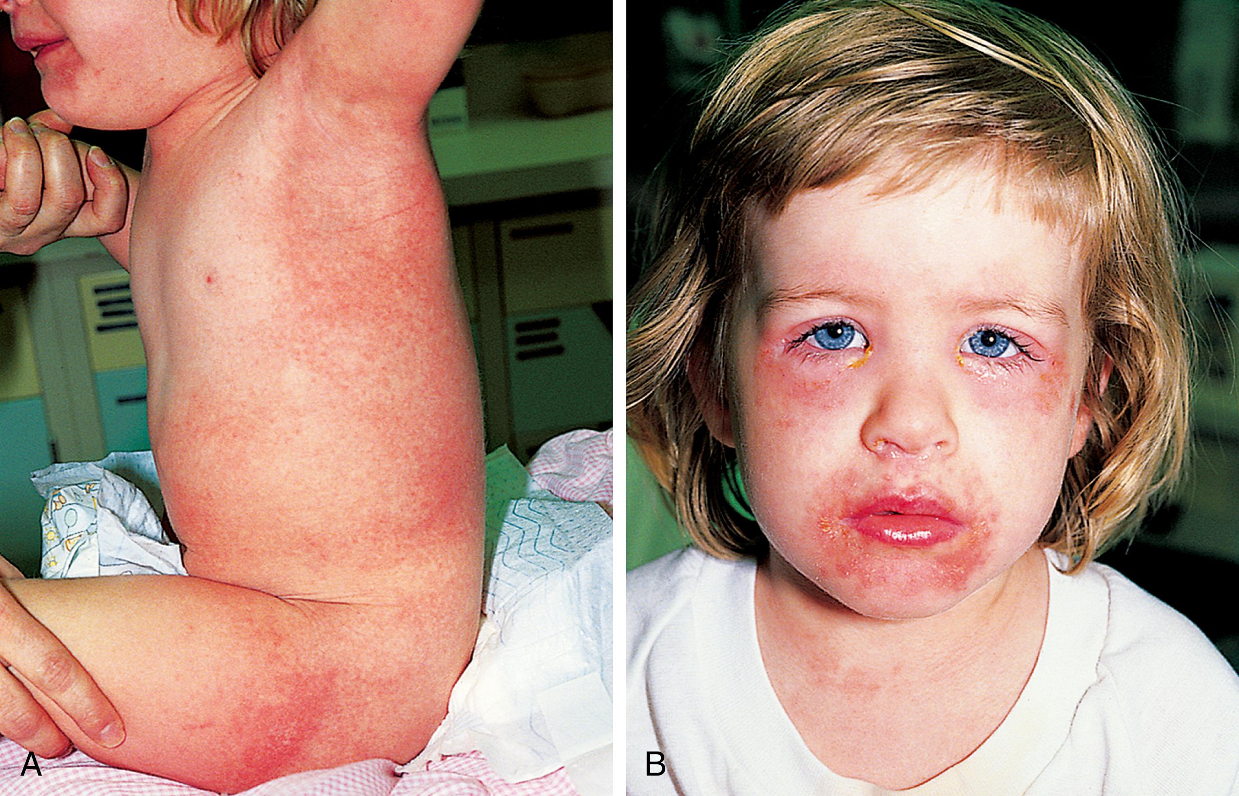 Fig. 13.19, Staphylococcal scarlet fever. (A) In this patient, nasopharyngitis and purulent conjunctivitis antedated the development of a generalized sandpaper-like rash, which was tender to the touch. (B) The skin in the periorbital and perioral areas has begun to crack, fissure, and weep serous fluid.